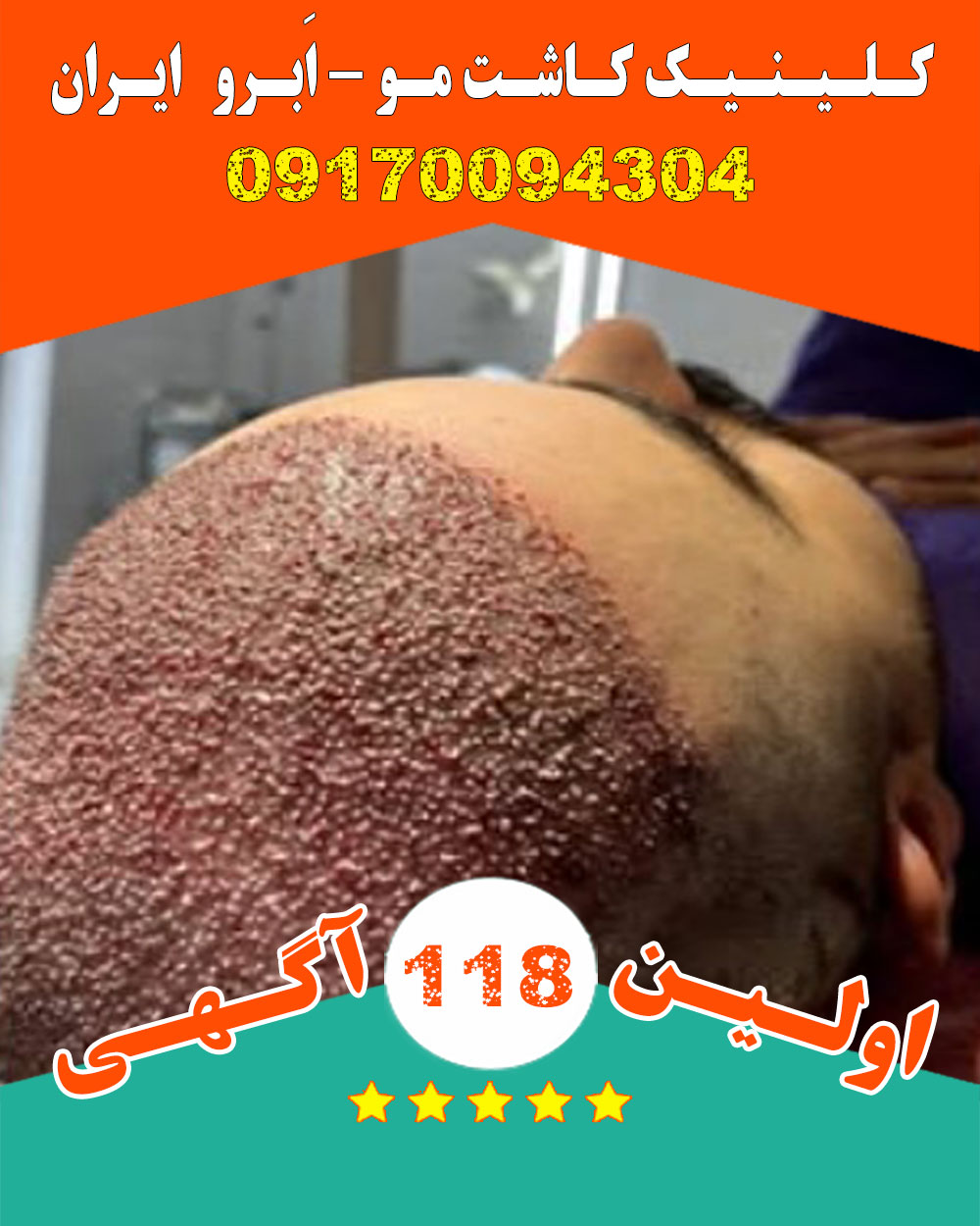 کلینیک کاشت مو ، اَبرو ایران در بیرجند دکتر رستمی