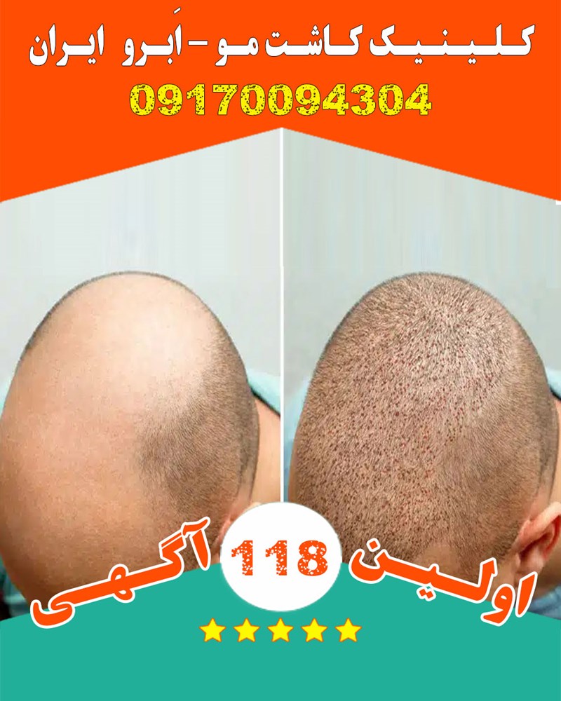 کلینیک کاشت مو ، اَبرو ایران 09170094304